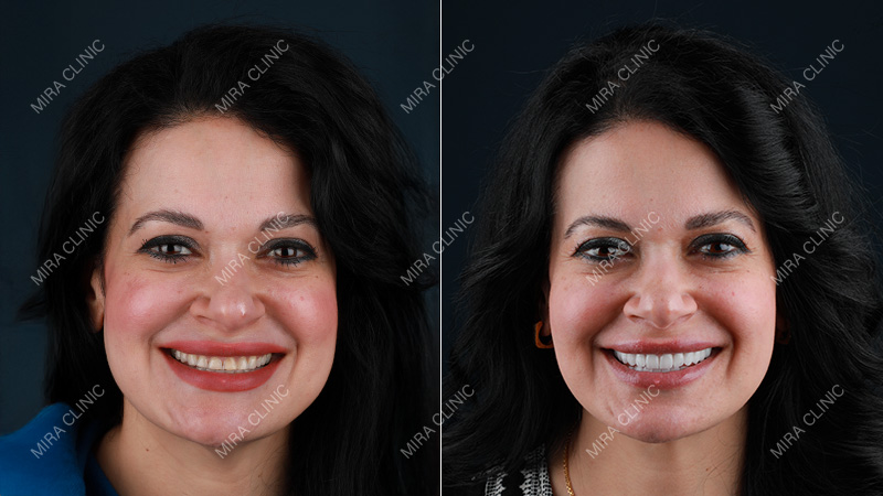 Hollywood Smile Decision